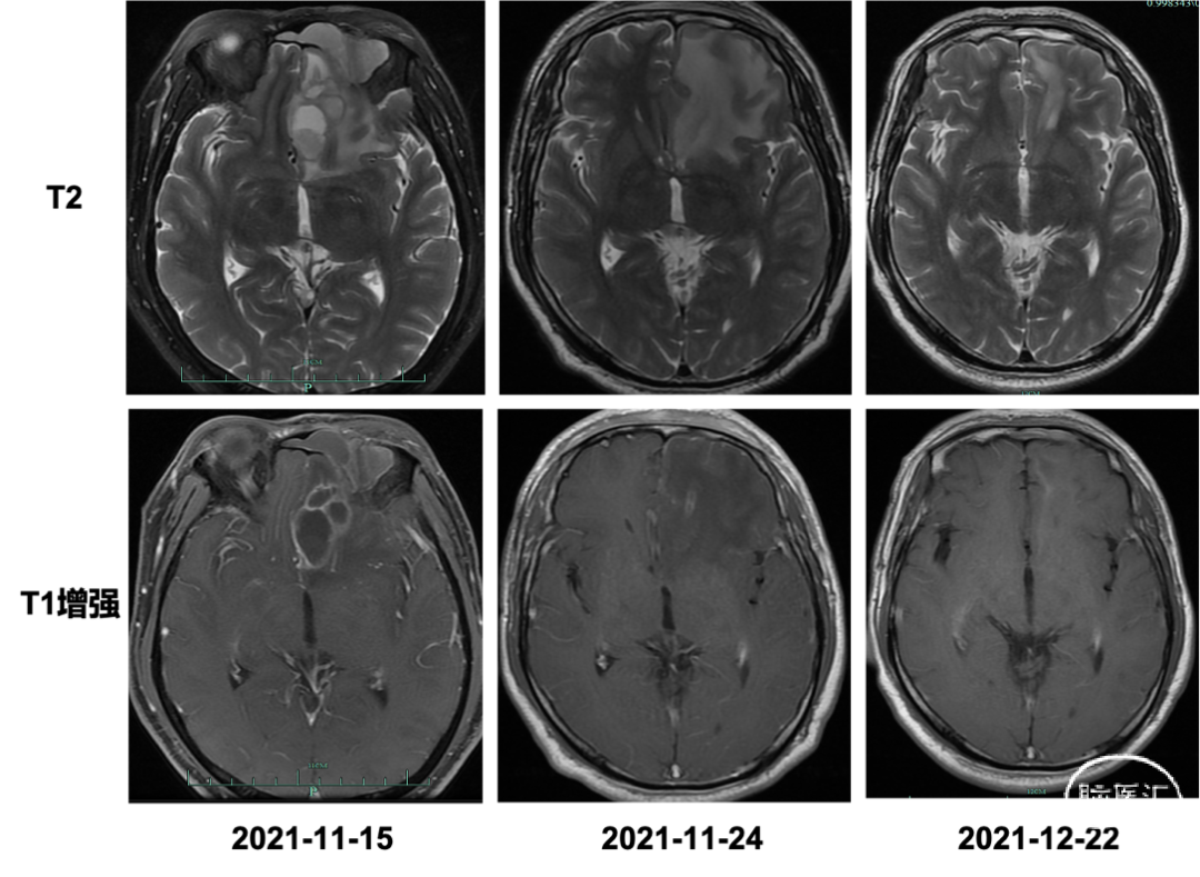 多模态磁共振成像及融合技术在颅脑恶性肿瘤放疗靶区勾画中的应用