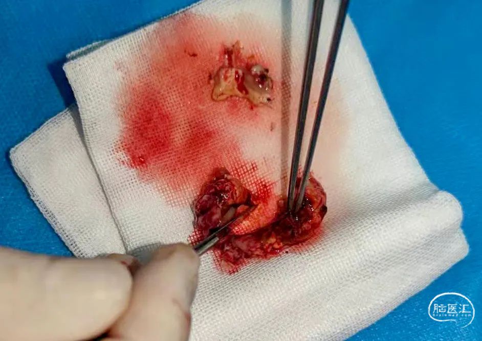 病例分享1例左颞内侧海绵状血管瘤术中皮质脑电监测辅助致痫病损切除