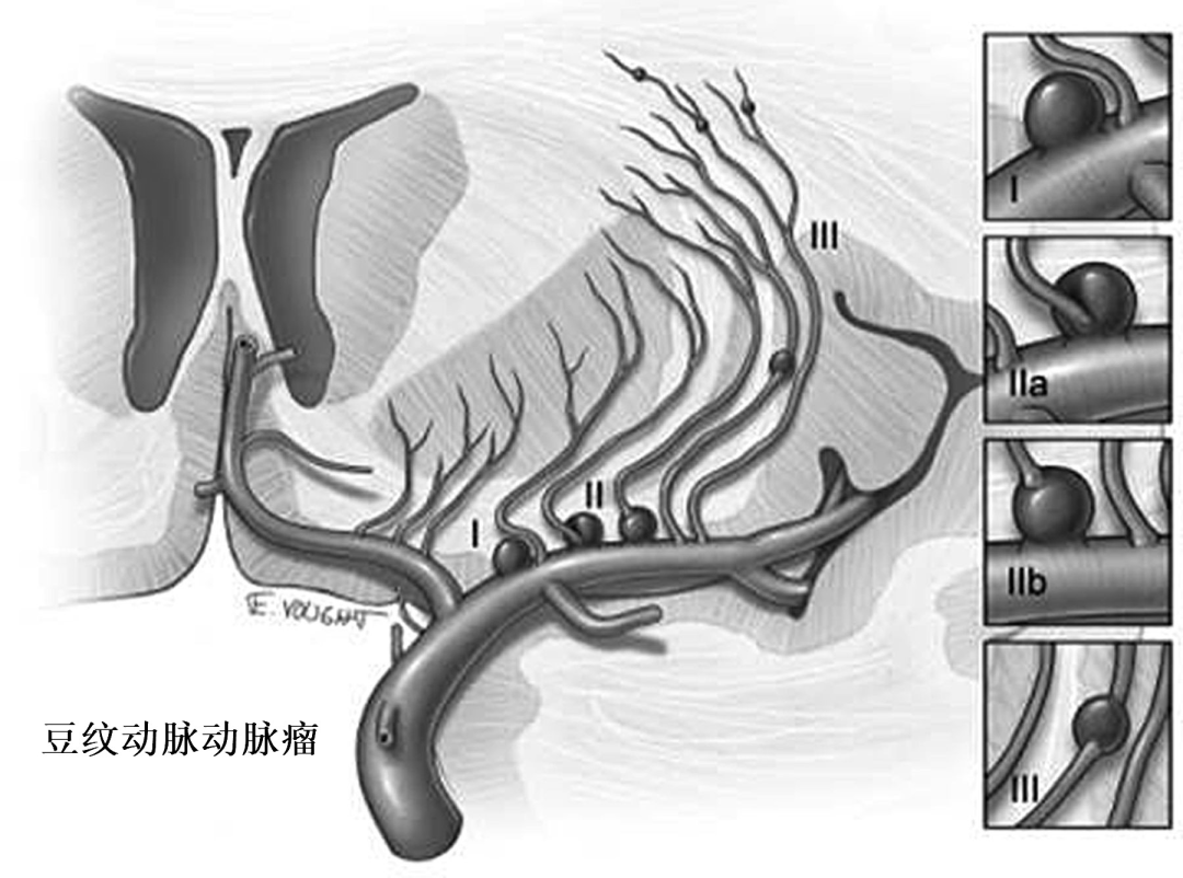 豆纹动脉解剖位置图片