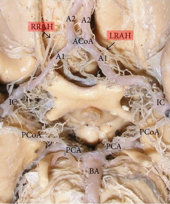 豆纹动脉解剖位置图片