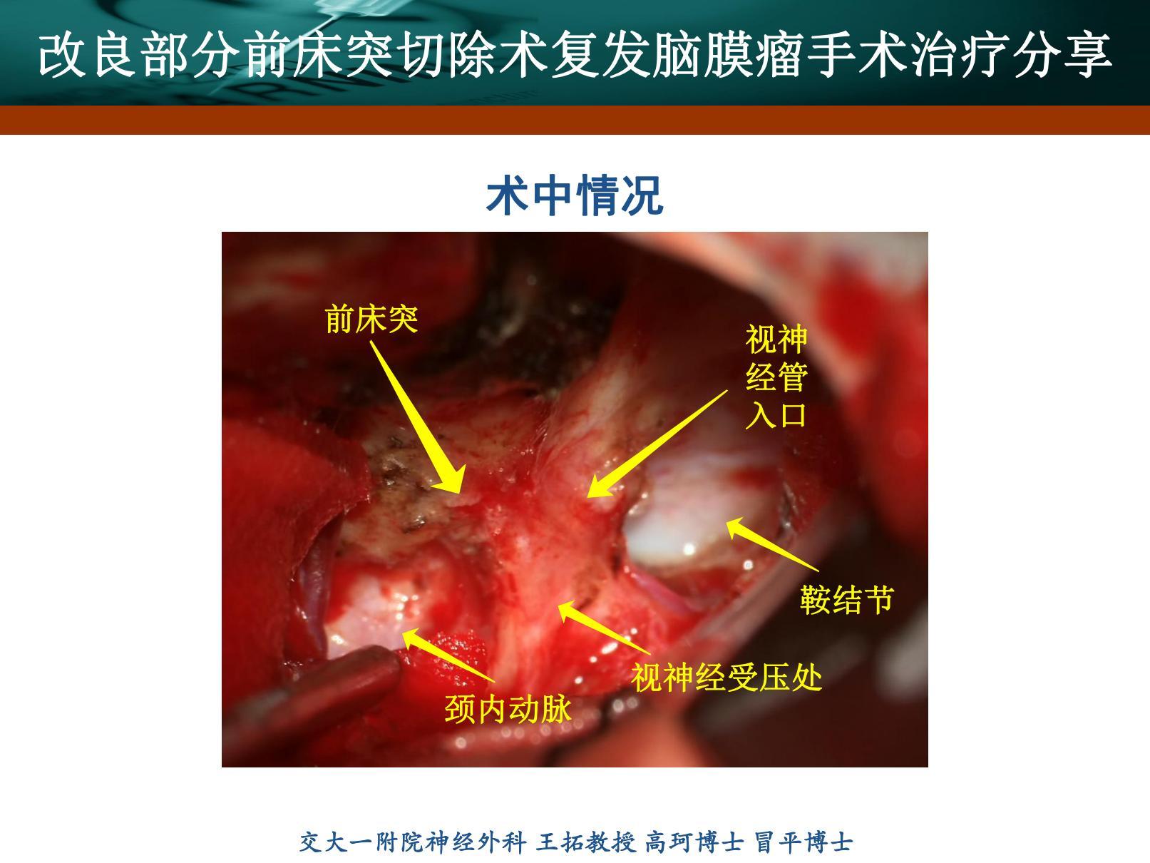 前床突脑膜瘤-刘书玲_20220217173504_05(1).jpg