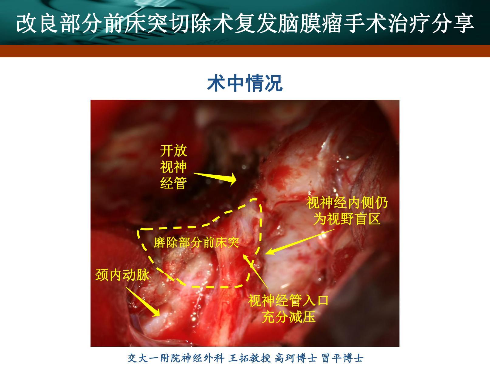 前床突脑膜瘤-刘书玲_20220217173504_06(1).jpg