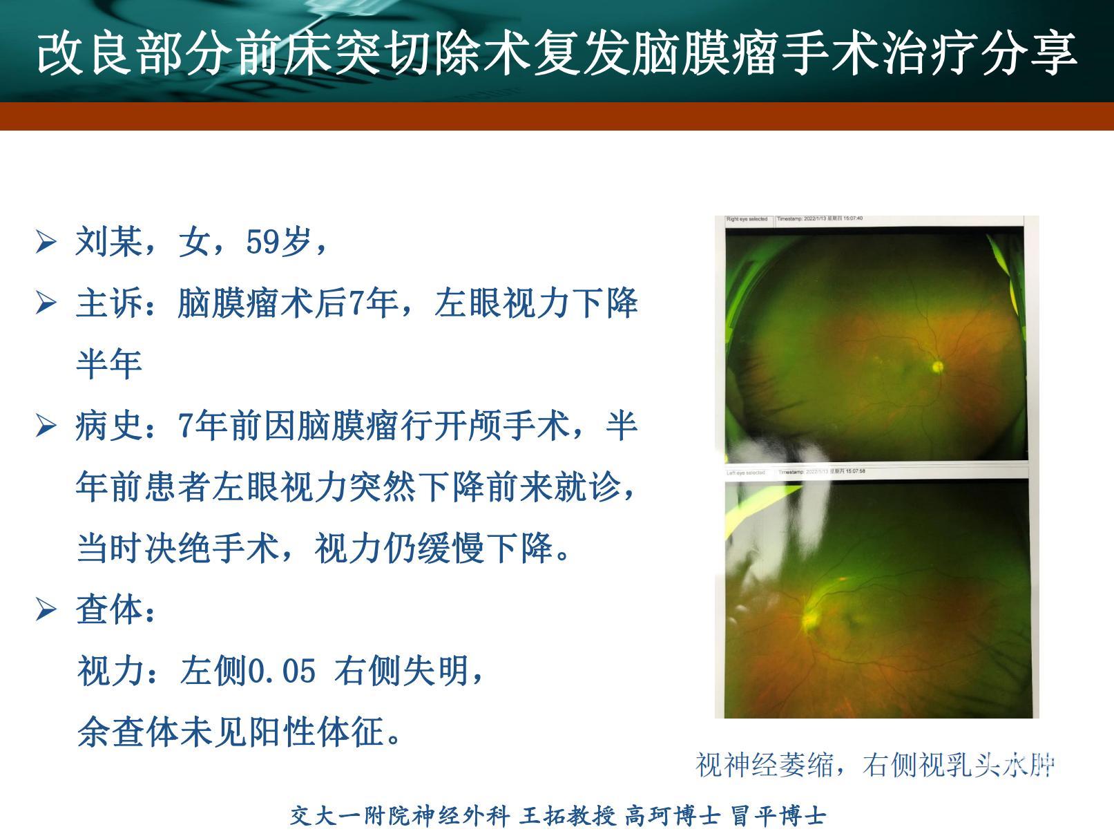 前床突脑膜瘤-刘书玲_20220217173504_01(1).jpg