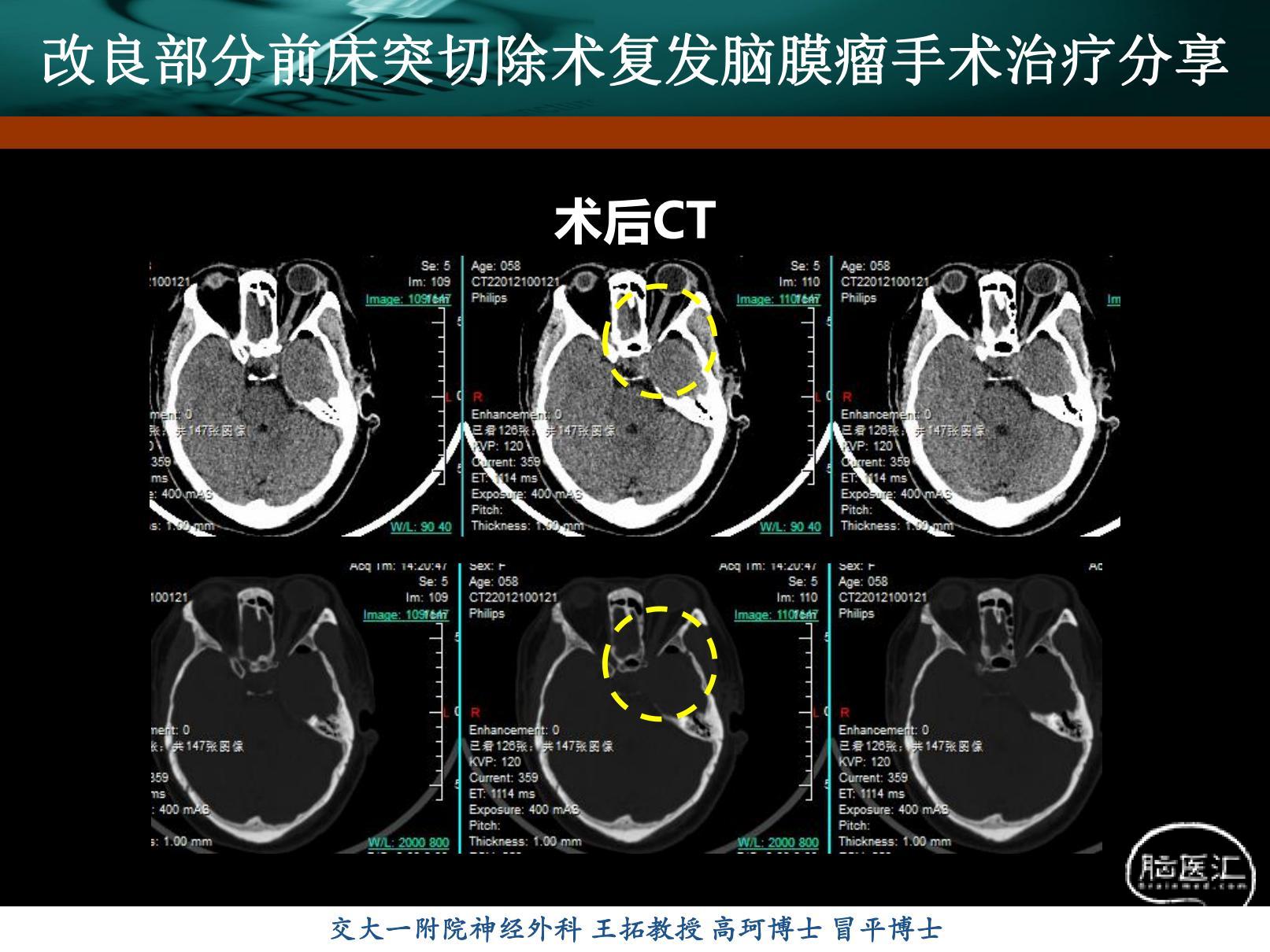 前床突脑膜瘤-刘书玲_20220217173504_07(1).jpg