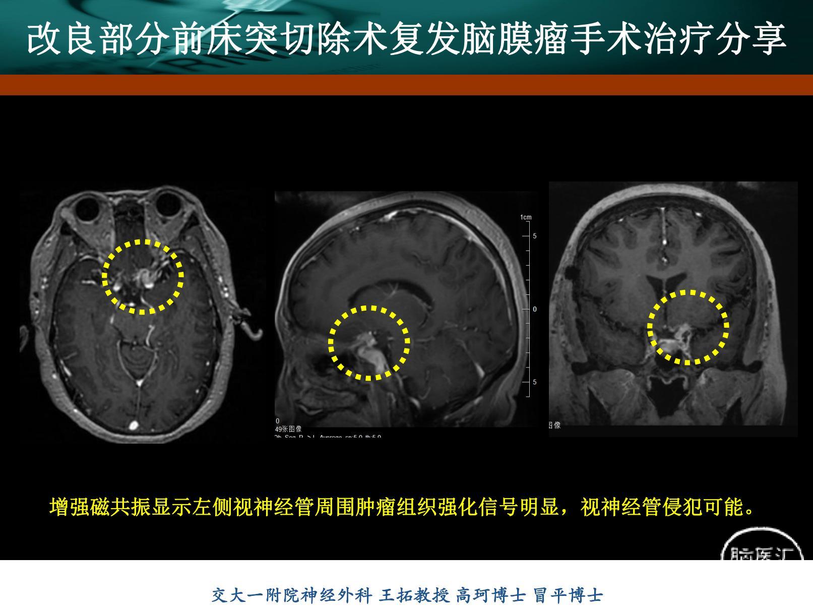 前床突脑膜瘤-刘书玲_20220217173504_02(1).jpg