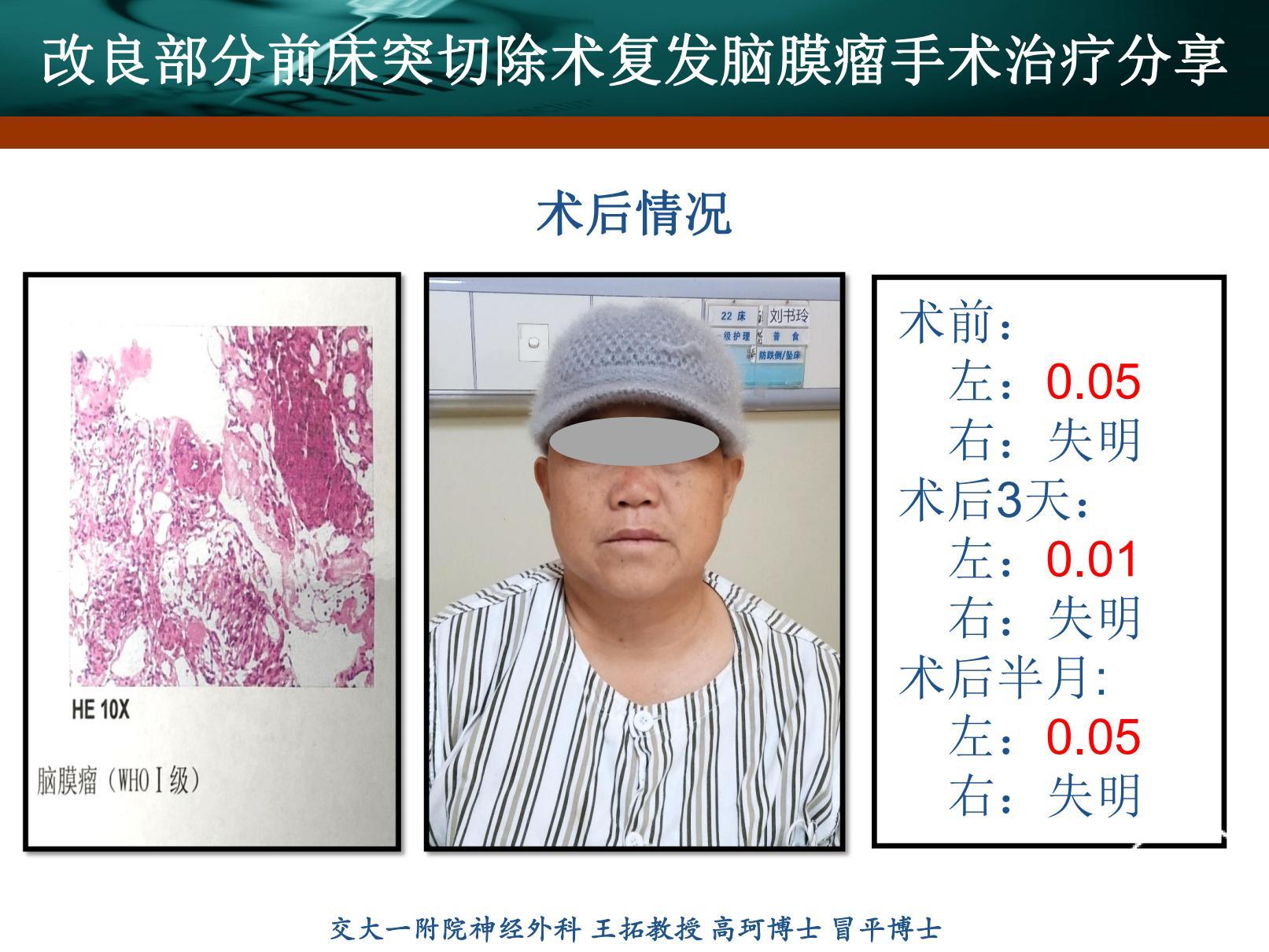前床突脑膜瘤-刘书玲_20220217173504_08(1).jpg