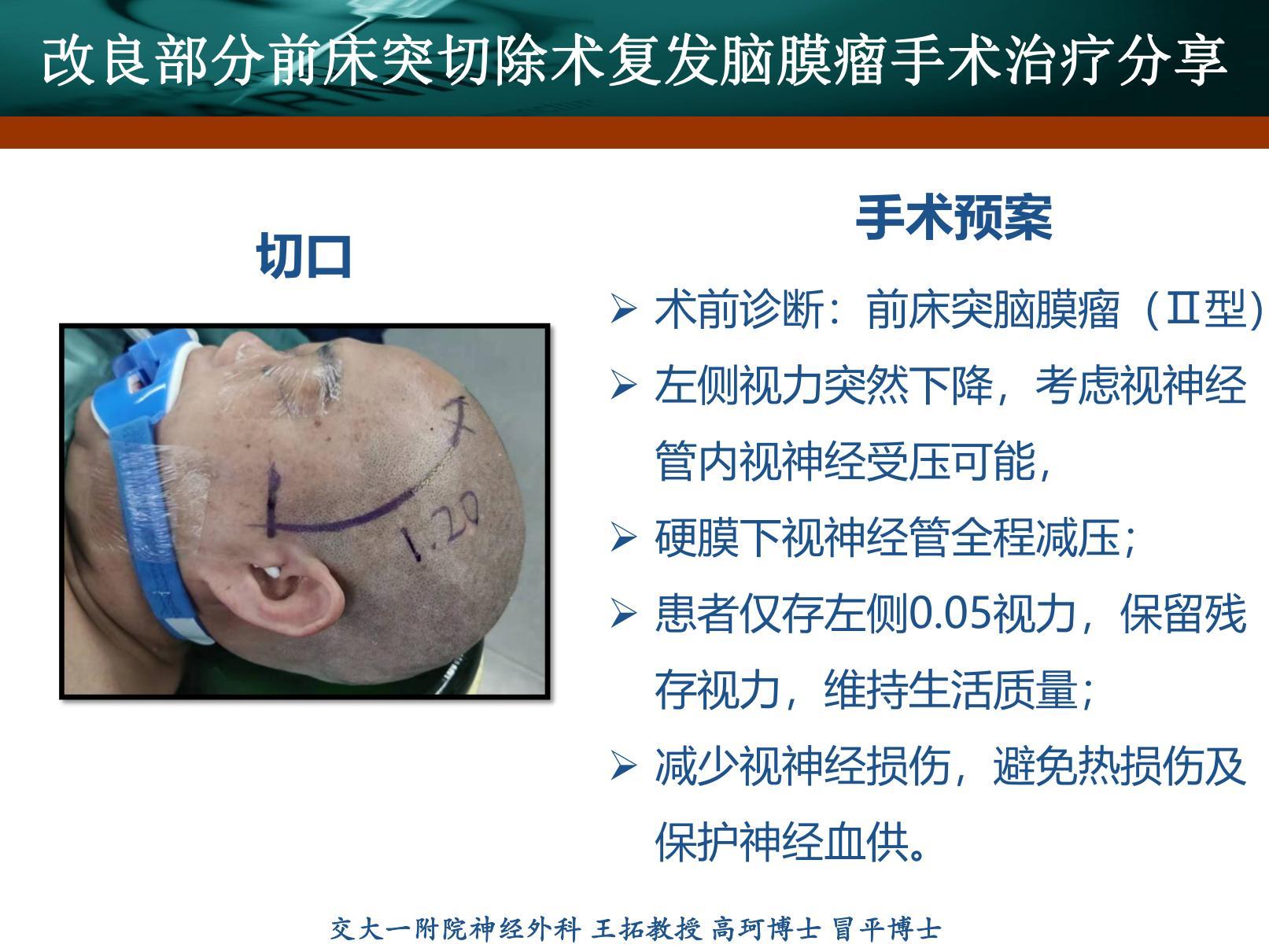 前床突脑膜瘤-刘书玲_20220217173504_03(1).jpg