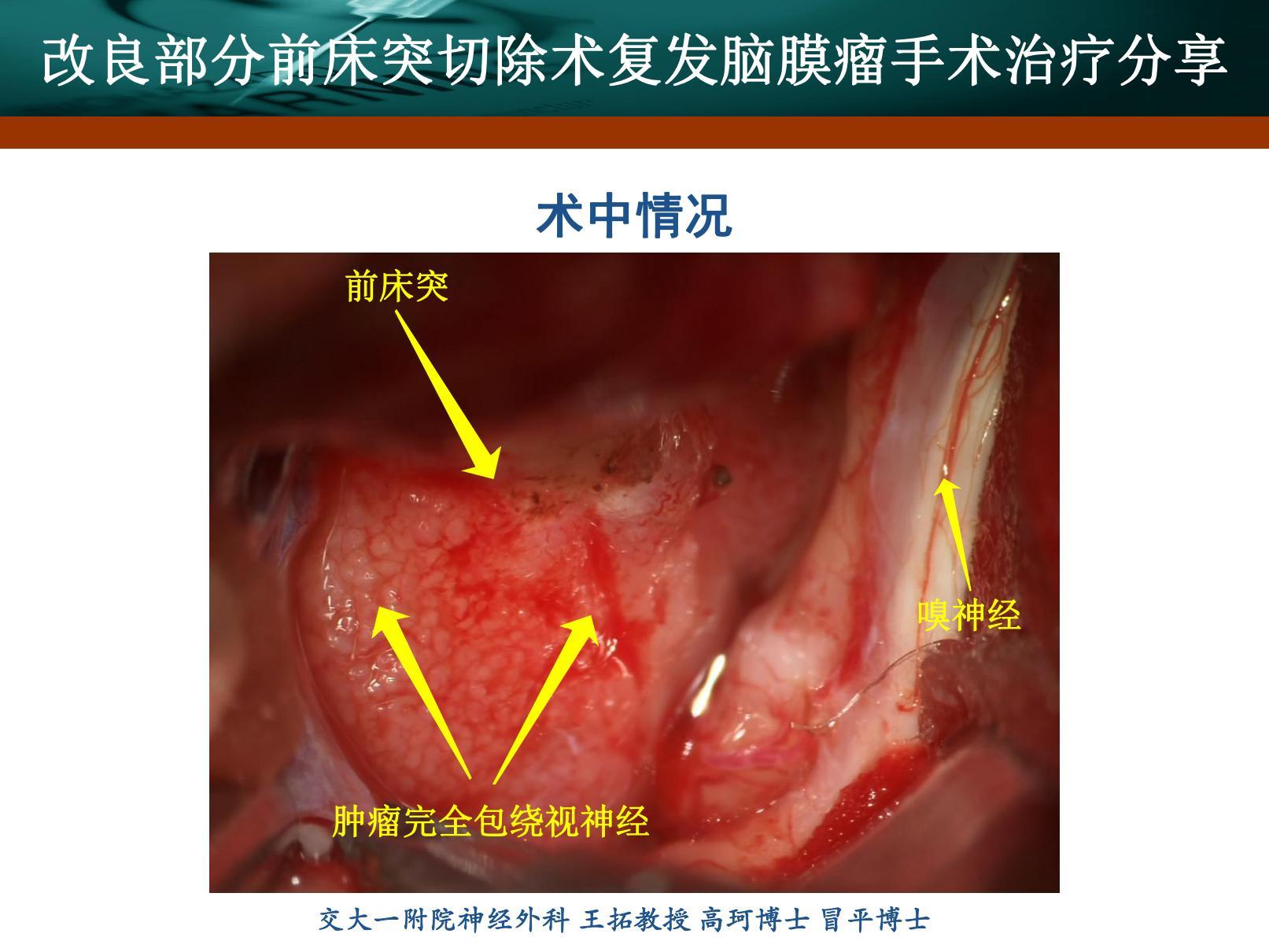 前床突脑膜瘤-刘书玲_20220217173504_04(1).jpg