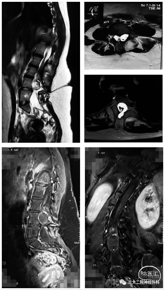 7. 腰骶段皮肤藏毛窦.6. 多节段先天性脊柱裂并蝴蝶椎;5.
