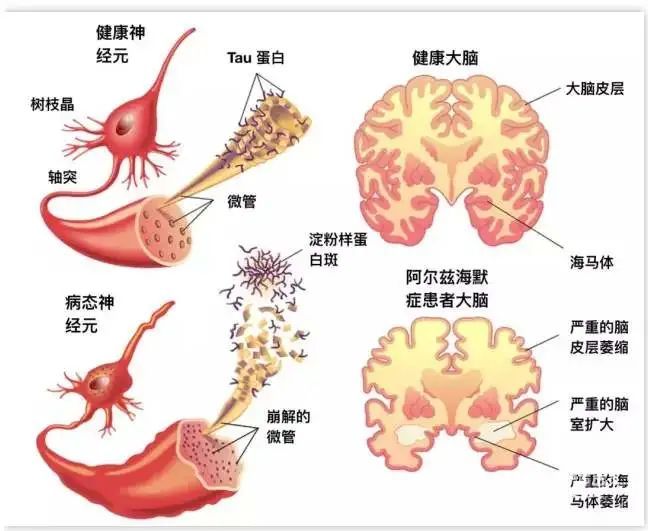 临床招募阿尔茨海默病治疗新曙光家有老人的都该看看