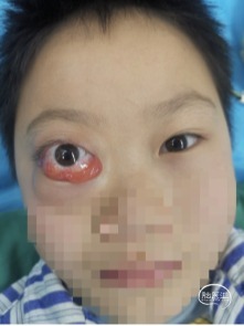 介入栓塞手术治疗儿童颈动脉海绵窦瘘一例