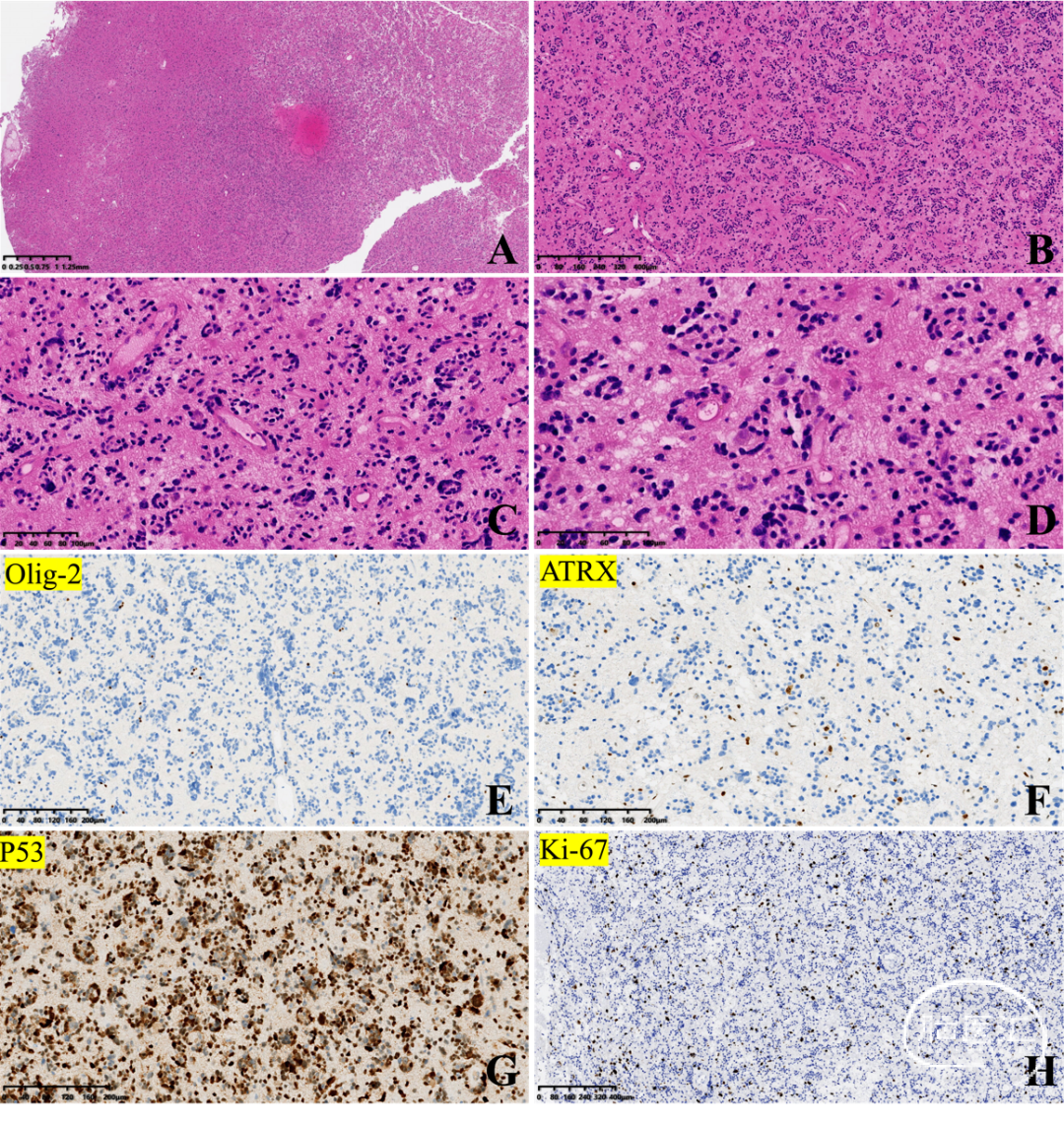 伴h3g34r突变的弥漫性半球胶质瘤一例神经病理系列二浙二神外周刊第