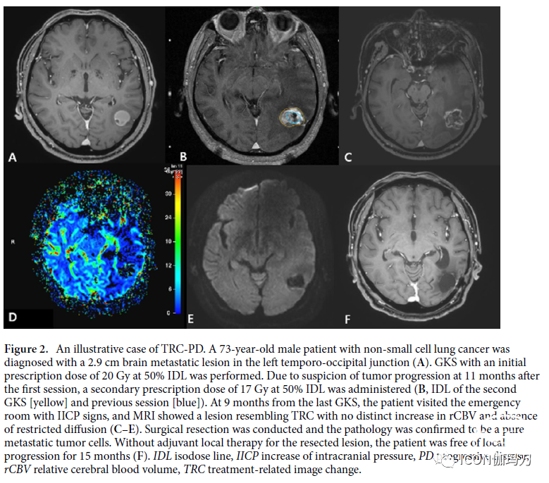 病理切片快递怎么包装【文献快递】脑转移瘤患者接受伽玛刀放射外科治疗后与治疗相关症状变化的组织病理学和手术结果_https://www.jmylbn.com_新闻资讯_第3张