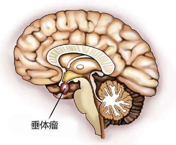 垂体位于大脑底部,是一个豆子大小的器官,当垂体出现肿瘤时,就会影响