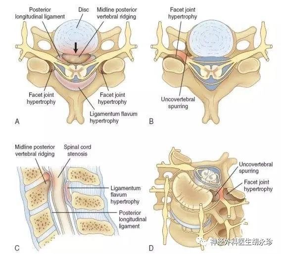 脊髓型颈椎病的手术治疗