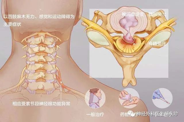 脊髓型颈椎病的手术治疗