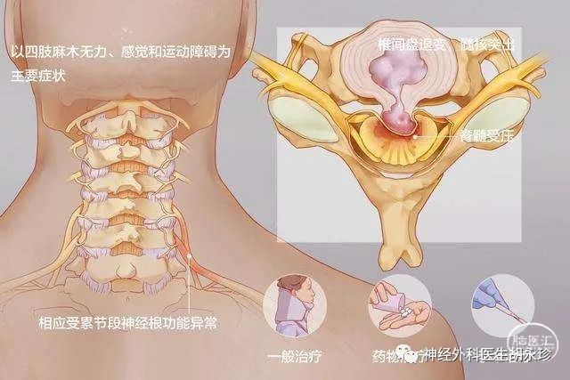 脊髓型頸椎病的手術治療