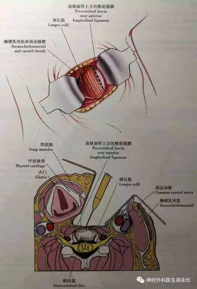 脊髓型颈椎病的手术治疗