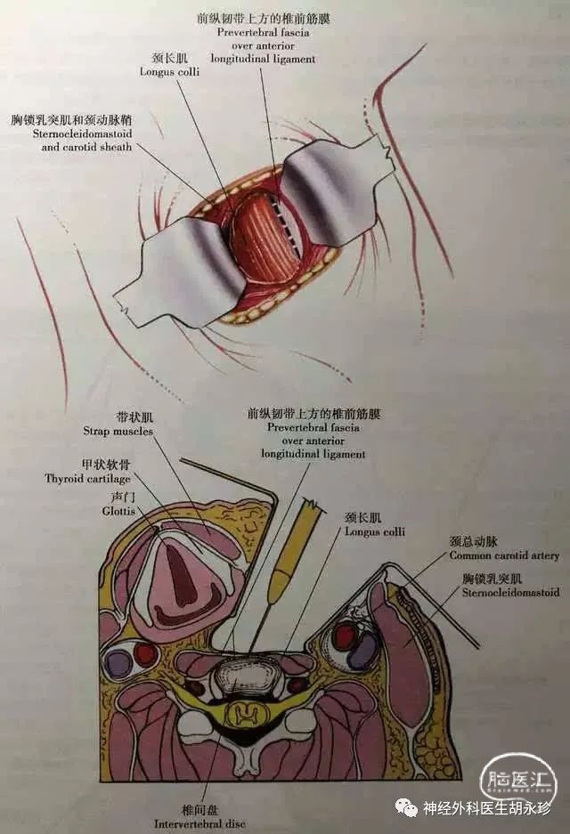 脊髓型頸椎病的手術治療