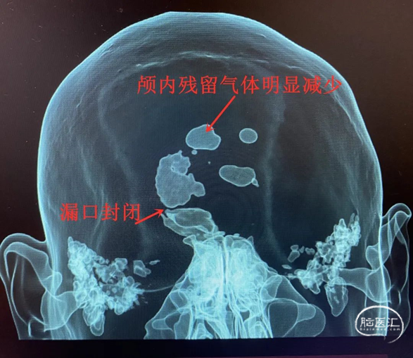 手術修補治療外傷後腦脊液漏