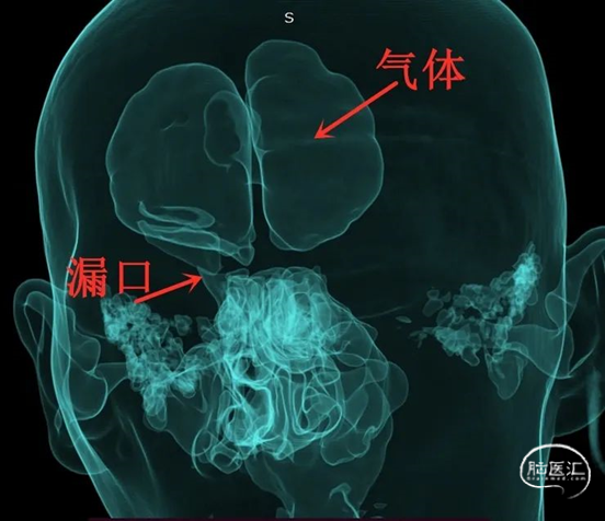 多模態融合特殊顯影蝶竇未見骨折入我院後行頭顱ct三維重建檢查:額骨