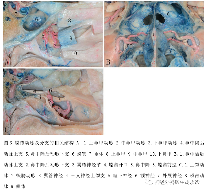 蝶顎動脈是上頜動脈的終末支,蝶顎動脈在翼顎窩內分為鼻中隔後動脈和