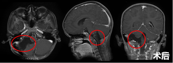 上海长征医院蒋磊副教授一例儿童后颅窝间变性室管膜瘤的诊治