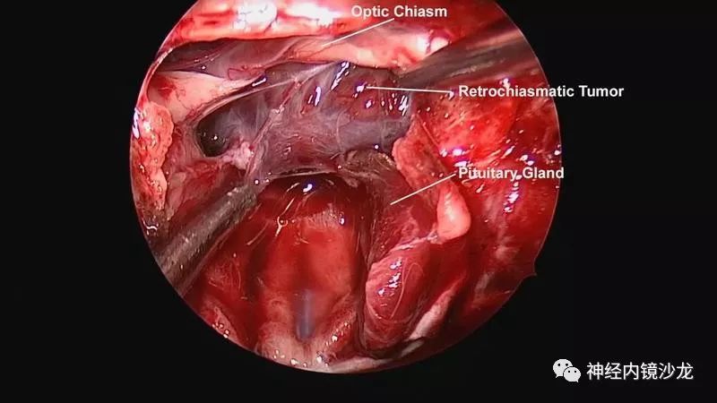 脑垂体切除图片