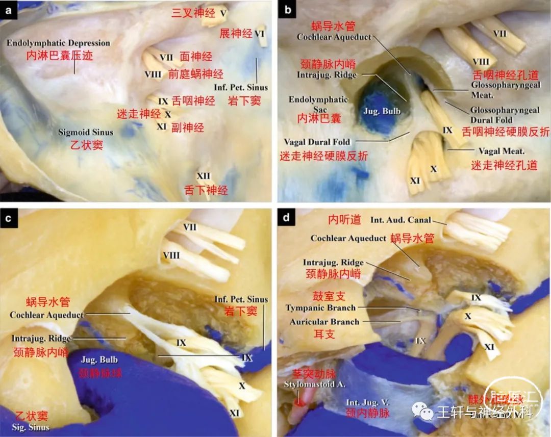 经典著作全译matsushima67颈静脉孔手术下