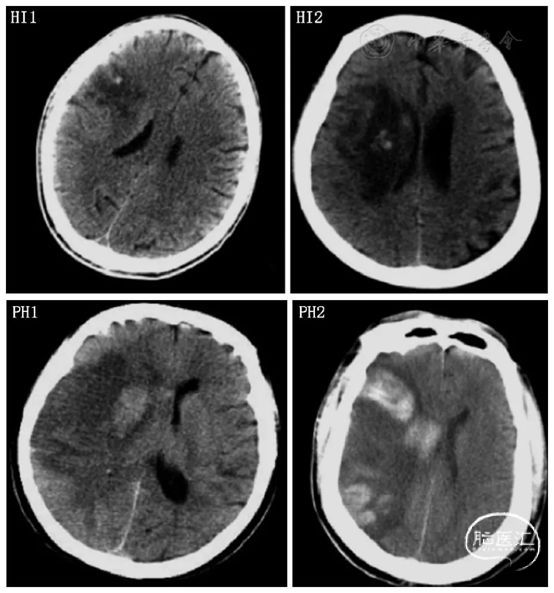 中国急性脑梗死后出血诊治专家共识 - 脑医汇 - 神外资讯 - 神介资讯