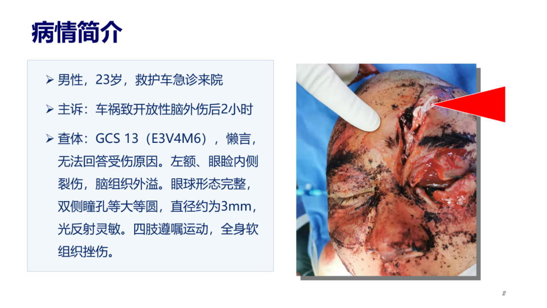 監測有道丨開放性腦外傷伴眶周複雜骨折救治一例顱腦創傷神經重症週刊