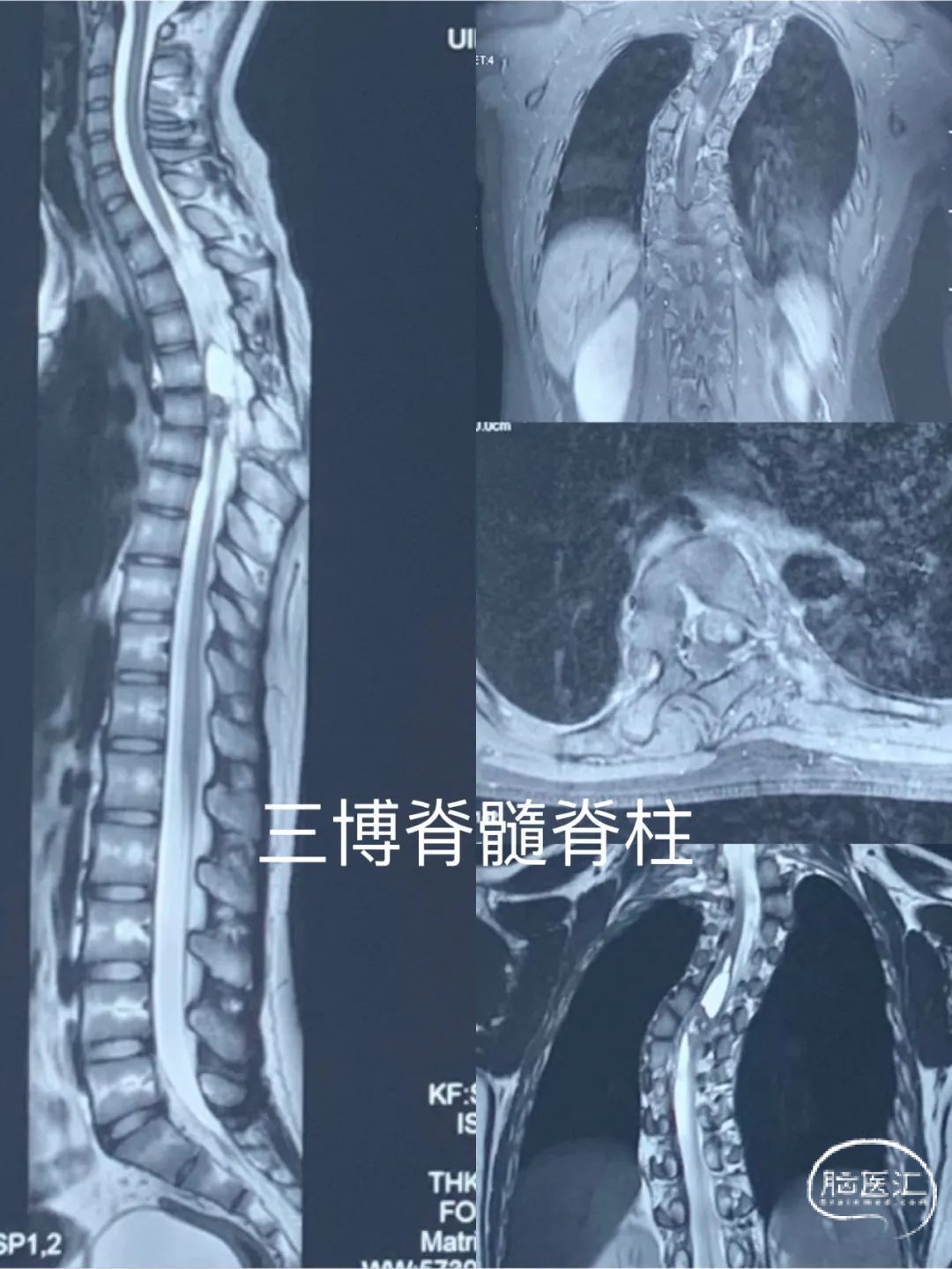 脊髓栓系综合征-外科学-医学
