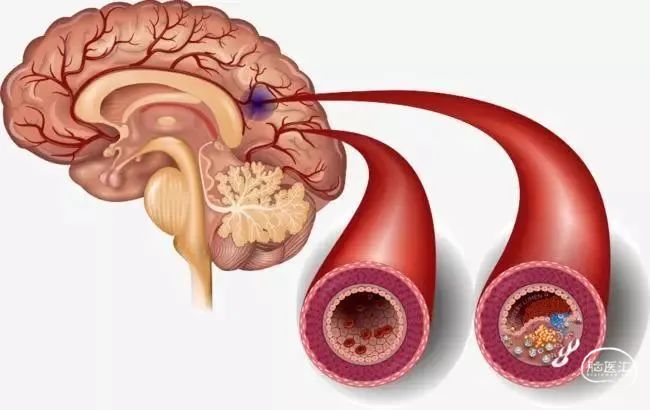 乍暖还寒最是脑梗多发季