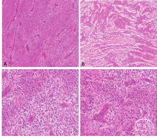 右额上皮样胶质母细胞瘤一例(神经病理系列九)---浙二神外周刊(第347
