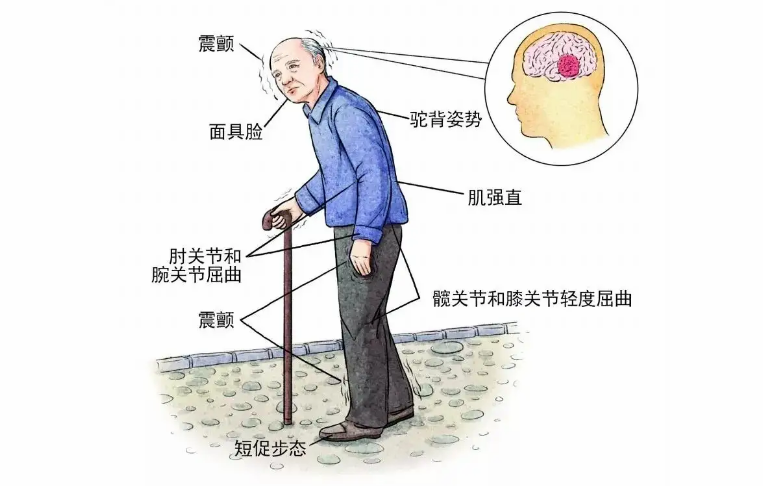 帕金森病主要症状图片图片