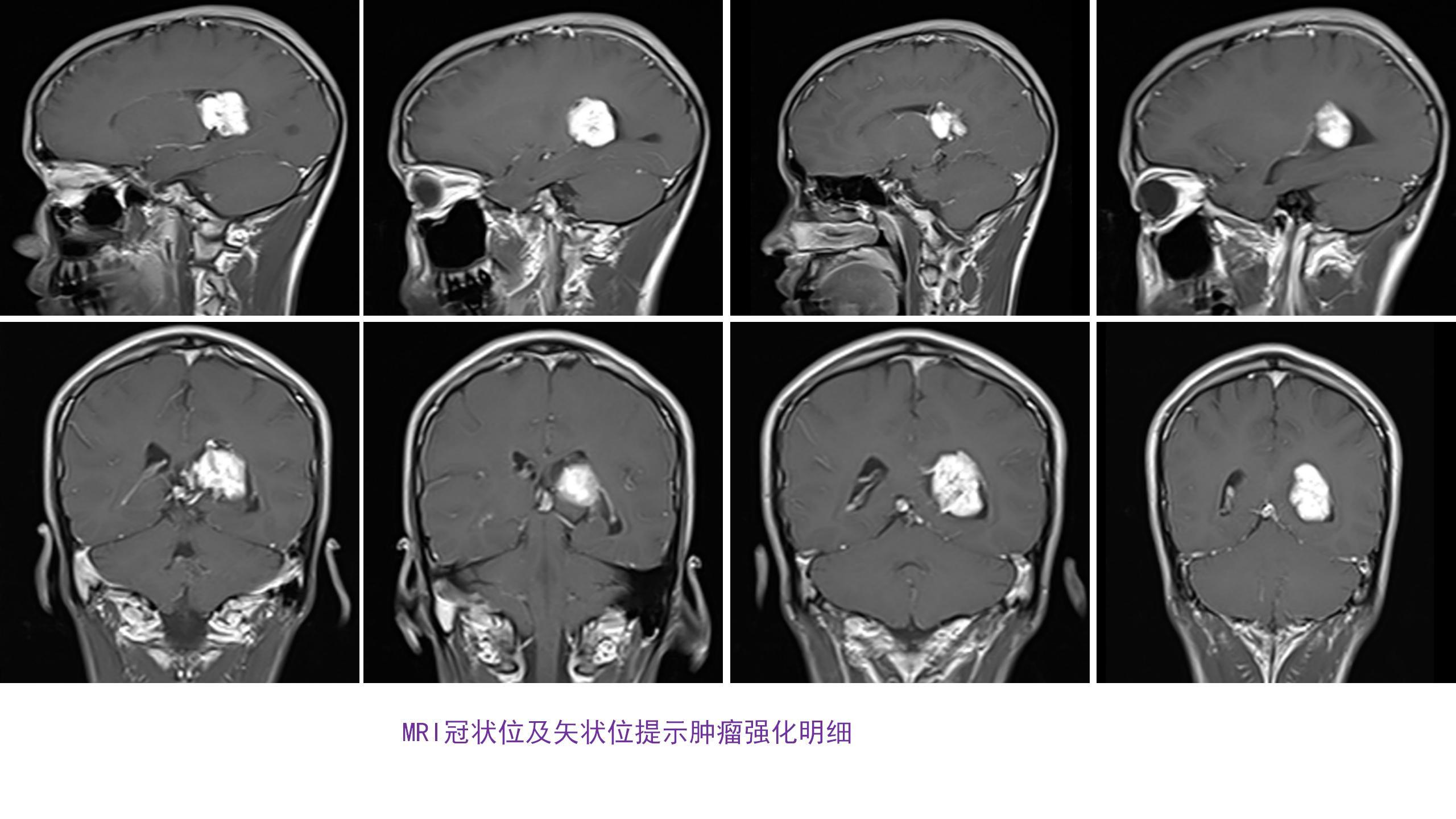 肖順武教授神經內鏡經同側楔前葉入路切除側腦室三角區少見血管母細胞