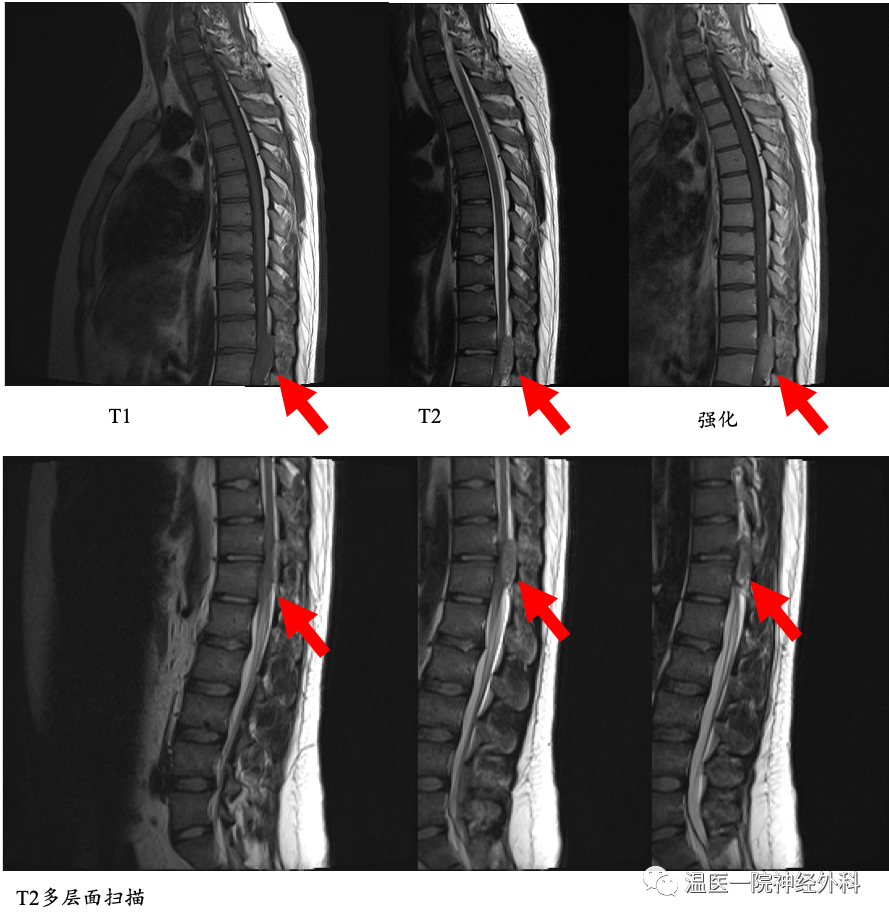 温医一院神经外科病例分享3脊柱硬脊膜外尤因肉瘤1例