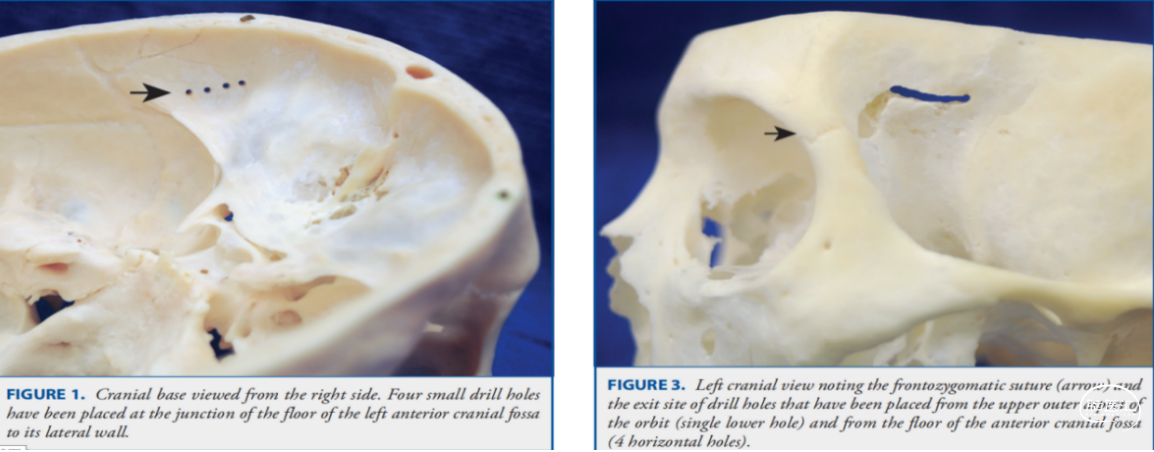 經典的maccarty孔可以達到骨孔最小,最精確暴露額葉外方的硬腦膜,眶壁