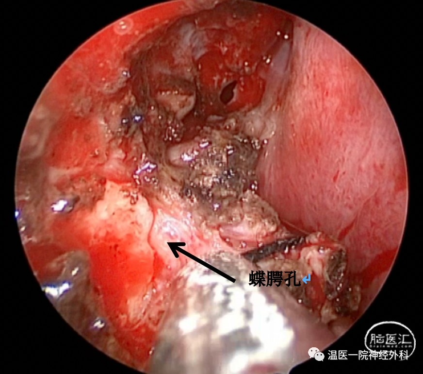 溫醫一院神經外科病例分享5蝶竇外側隱窩腦脊液漏1例內鏡下經翼突入路
