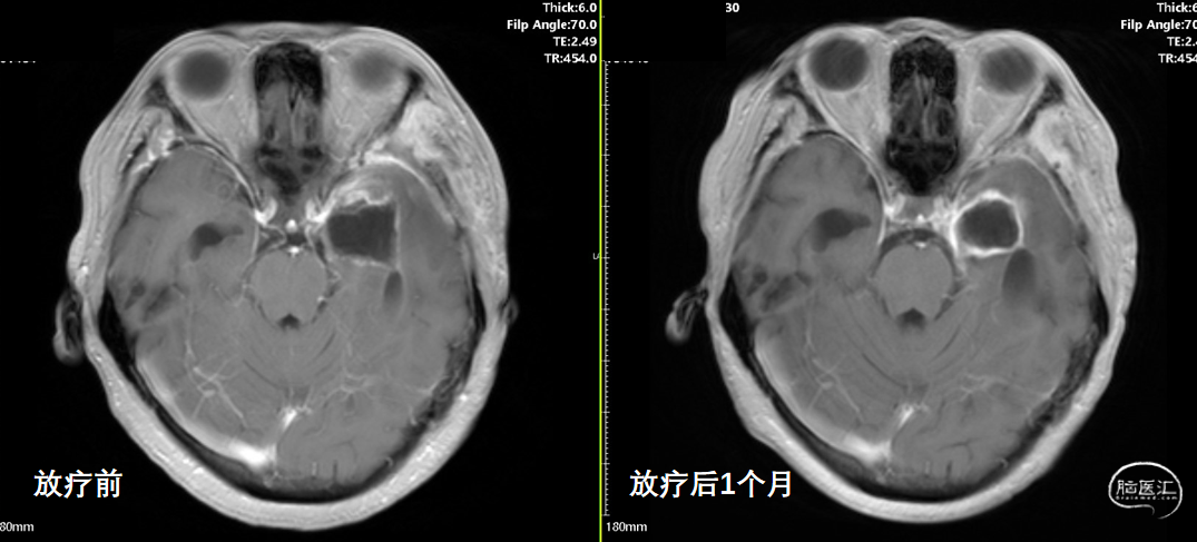 一例左顳葉膠質母細胞瘤患者who4級術後輔助tmz聯合腫瘤電場治療治療