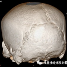 muenke综合征颅缝早闭的影像特点 