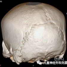 muenke综合征颅缝早闭的影像特点