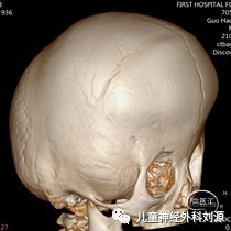 muenke综合征颅缝早闭的影像特点