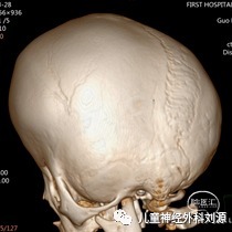 muenke综合征颅缝早闭的影像特点