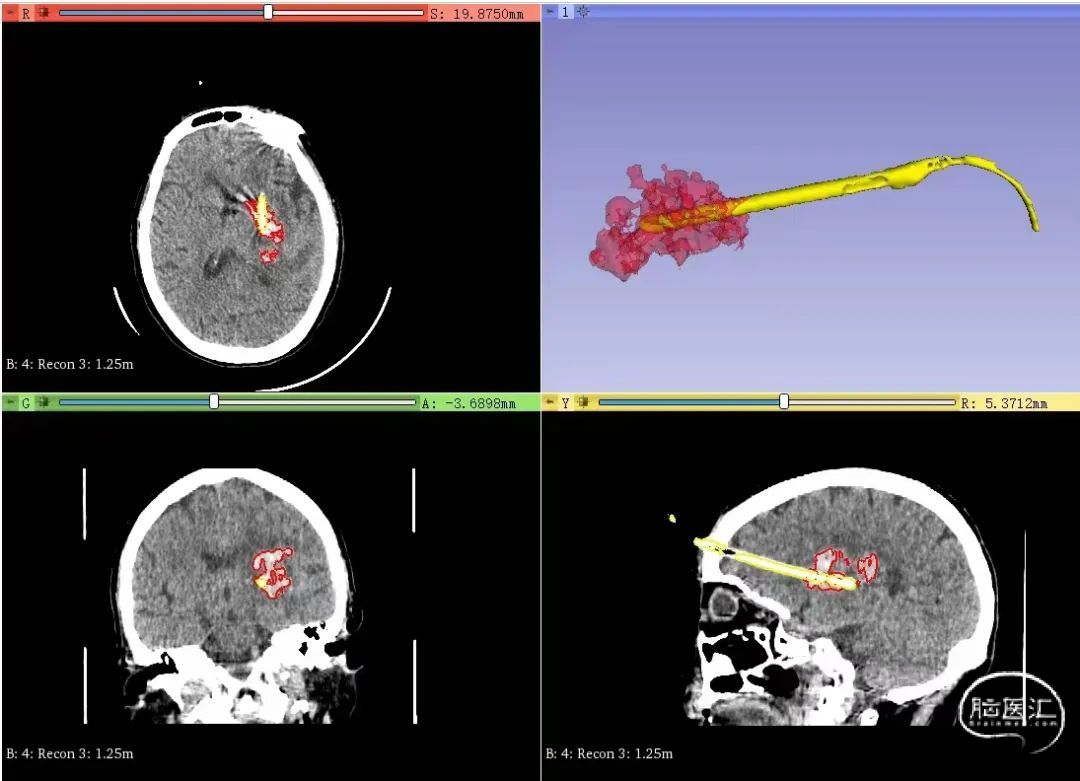3d Slicer下高龄脑出血3d打印微创手术治疗 脑医汇 神外资讯 神介资讯 7908