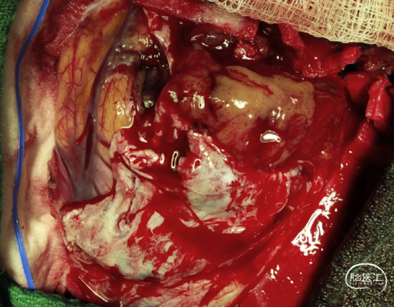 温医一院神经外科病例分享9颅内磷酸盐尿性间叶肿瘤1例