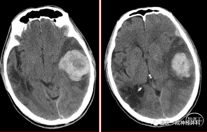 温医一院神经外科病例分享9颅内磷酸盐尿性间叶肿瘤1例