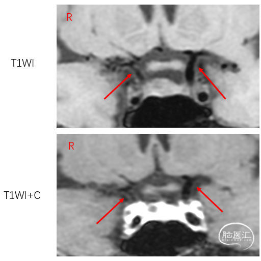 高分核磁的重要性：两例“烟雾病”的病因鉴别诊断 脑医汇 神外资讯 神介资讯
