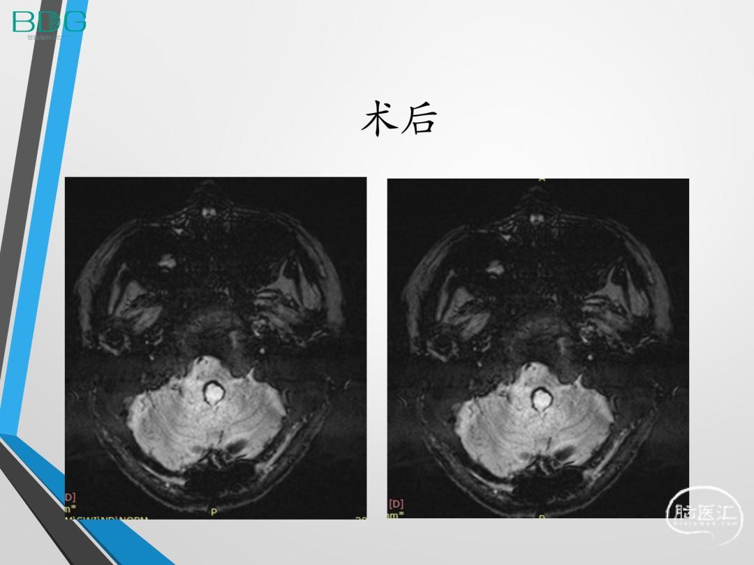延髓海绵状血管瘤_11.jpg
