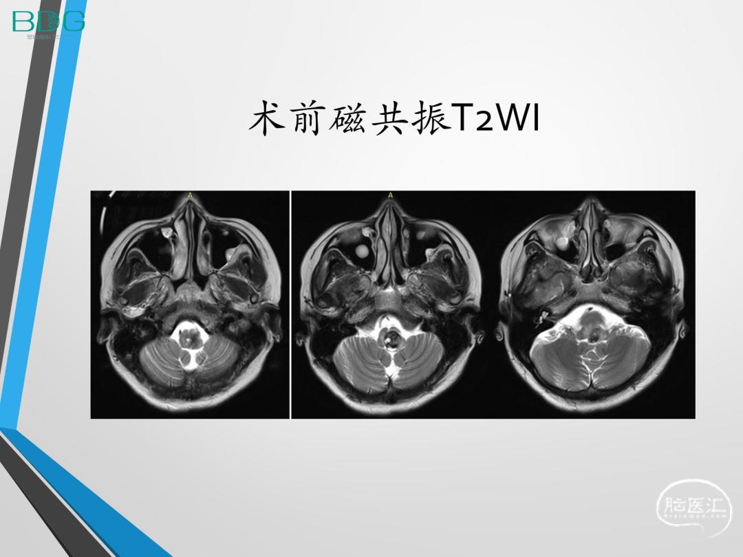 上海冬雷脑科医院张学军 刘旻谛 肖炳祥 宋冬雷 延髓海绵状血管瘤一例